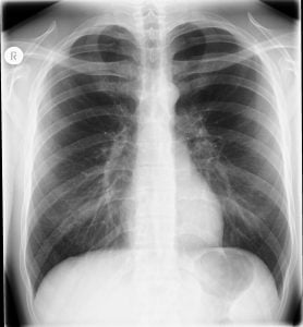 Radiation X-Ray Image